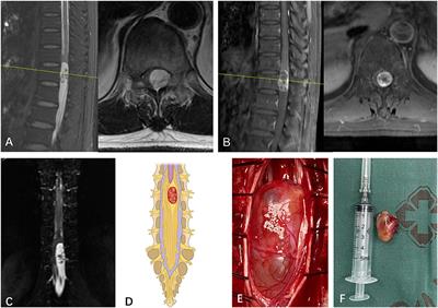 Case Report: The Coronal Magnetic Resonance Imaging of Three-Dimensional Fast-Field Echo With Water-Selective Excitation Can Identify the Wrapping of Spinal Nerve Fibers Into Subdural Tumors Prior to Operation